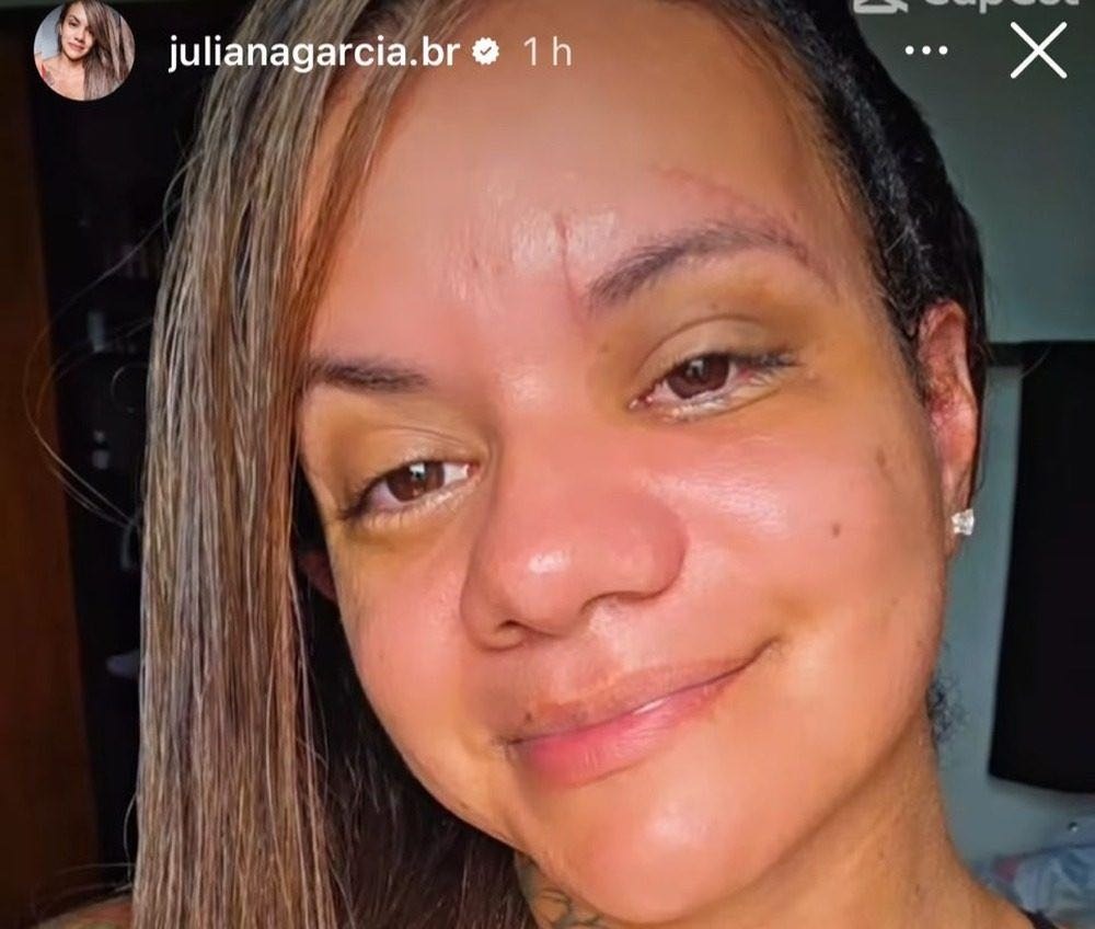 Juliana Soares, agredida com 61 socos, mostra seu rosto um mês após cirurgias; ASSISTA