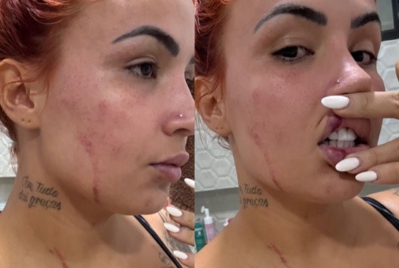 Influenciadora “Ruivinha” é baleada e denuncia ex-marido por tentativa de feminicídio em João Pessoa