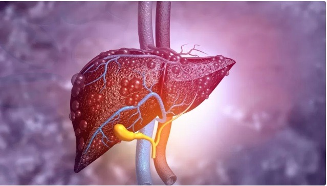 Gordura no fígado: por que diagnóstico é tão comum e perigoso?