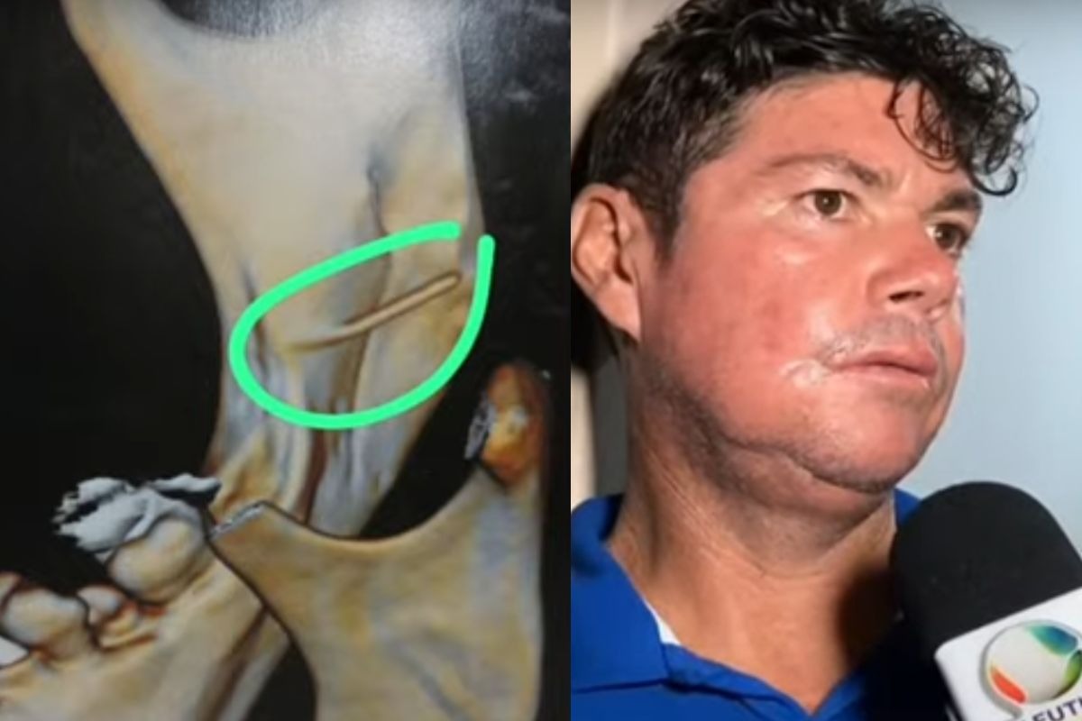 Homem vai ao posto de saúde retirar dente e sai com agulha na boca no interior do RN