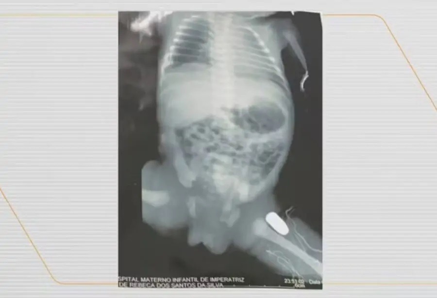 Grávida é baleada e tiro fica alojado na perna do bebê