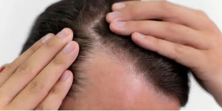 Novo estudo revela uma possível cura eficaz para a calvície; veja resultados