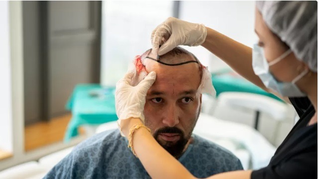 Transplante de cabelo vale a pena? O que ninguém te conta sobre os riscos