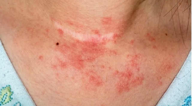 Por que a dermatite piora no calor? Como proteger a pele em dias quentes