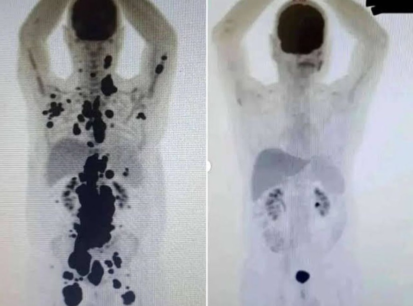 Paciente com câncer tem remissão completa após terapia inovadora