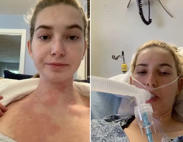 Mulher com alergia severa só pode beijar depois de 'questionário'; entenda