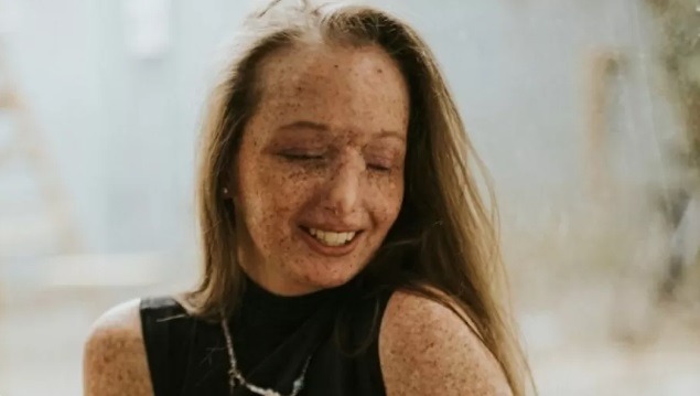 Ela não pode se expor ao sol: 'Surgem feridas e até tomar banho é dolorido'