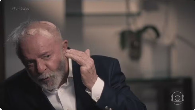 Lula conta que está com furos na cabeça e mostra curativos