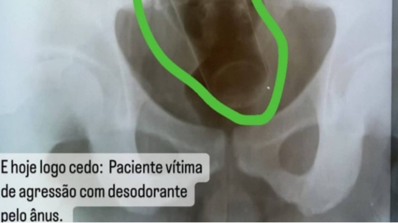 Médico é demitido por vazar raio-x de paciente com desodorante no ânus