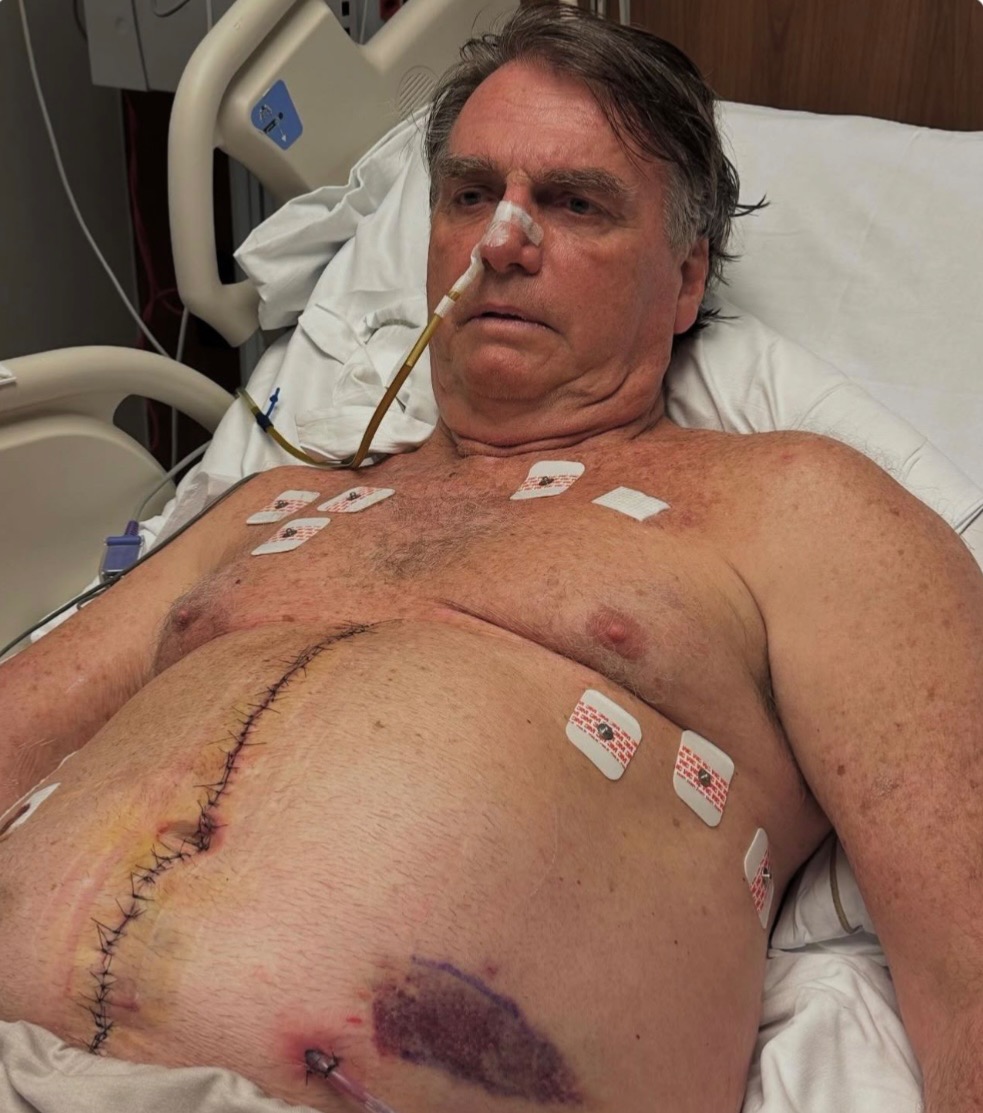 Impressionante: Bolsonaro mostra imagem da cicatriz na barriga