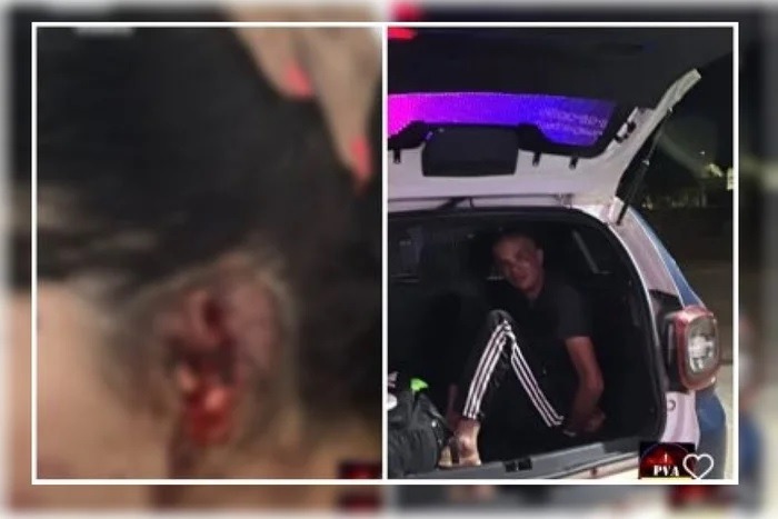 Ciúmes canibal: mulher tem pedaço da orelha arrancado pelo marido