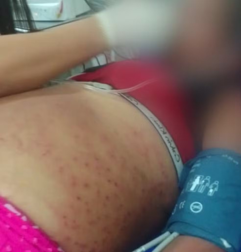 Após 1 mês, mulher que levou 1,5 mil picadas de abelhas deixa hospital na Grande Natal