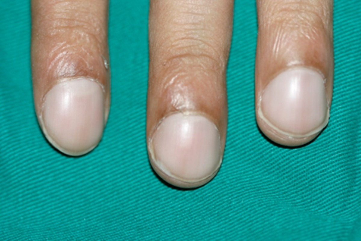 Homem percebe alteração nas unhas e descobre ter câncer de pulmão
