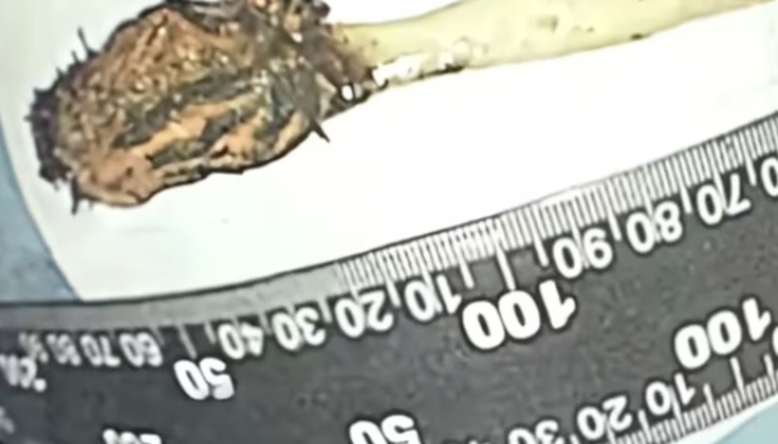 Homem descobre que escova de dente engolida na infância estava presa no intestino há 52 anos