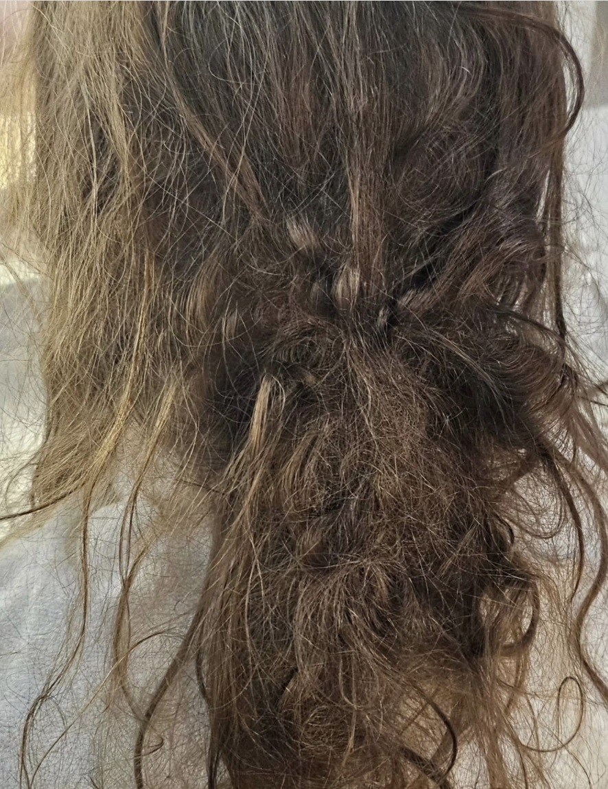 Adolescente sobrevive a grave afogamento após cabelo prender em ralo de piscina no RN