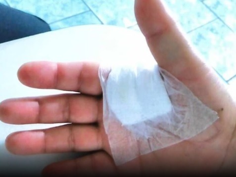 Médico é condenado a indenizar paciente após cirurgia em dedo errado
