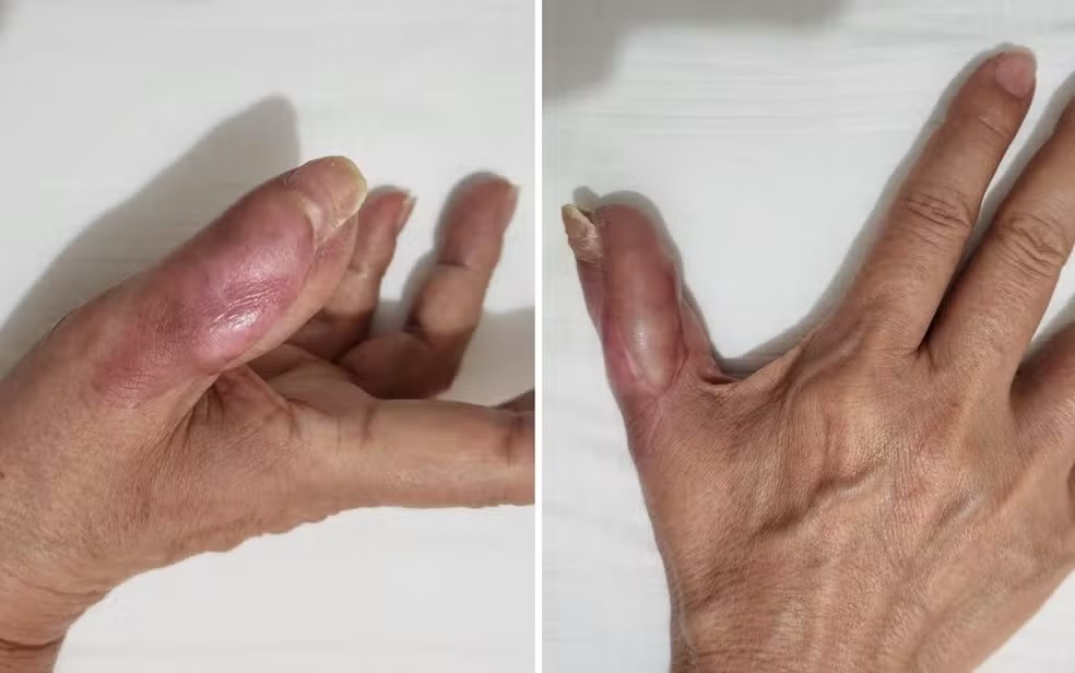 Mulher perde parte do dedo após fazer a unha em salão