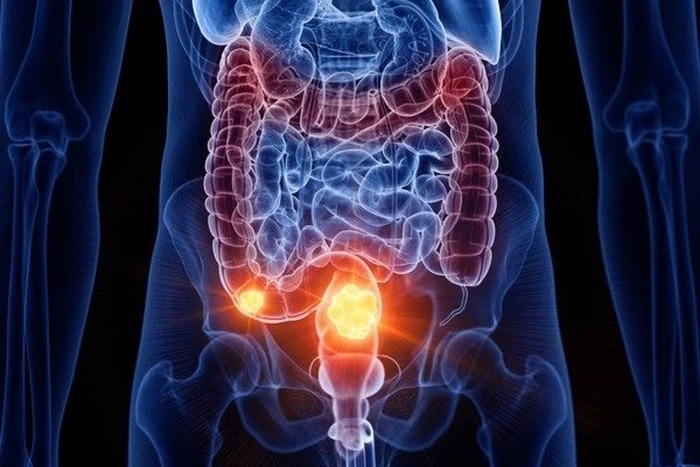 Câncer de intestino: saiba como é feita e quando começar a prevenção