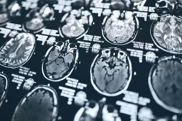 Idosa que apanhava de cuidadora tem Alzheimer em grau avançado