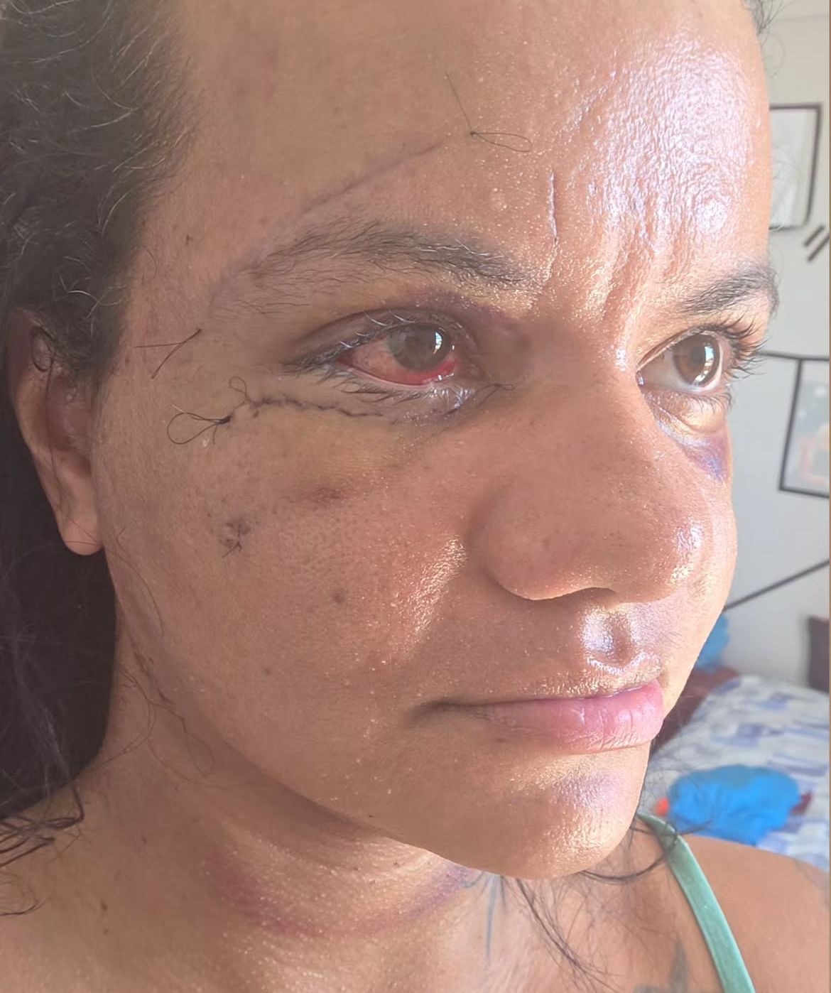 Após levar 61 socos dentro do elevador, Juliana Soares mostra rosto 7 dias após cirurgia reparadora