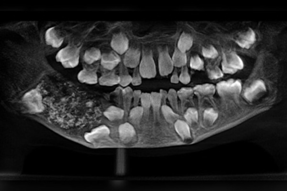Menino de 7 anos tem 526 dentes retirados em cirurgia na Índia
