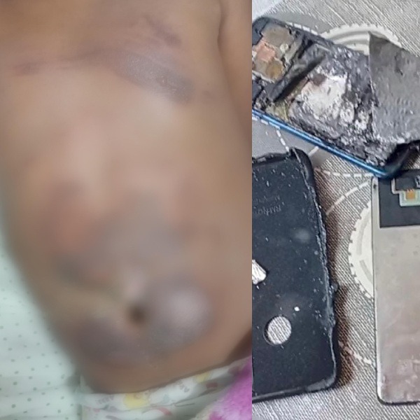 Criança de 10 anos sofre queimaduras após celular pegar fogo no interior do RN