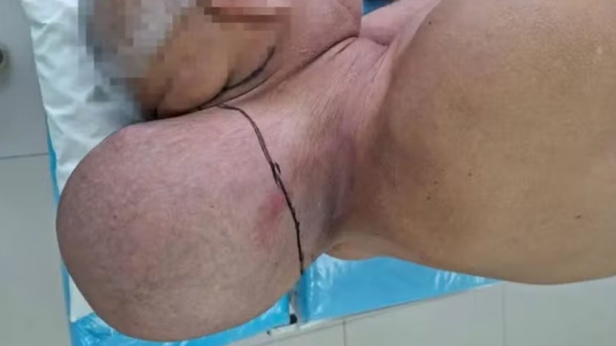Após mais de 15 anos com ‘segunda cabeça’, idoso passa por cirurgia para remoção de tumor gigante