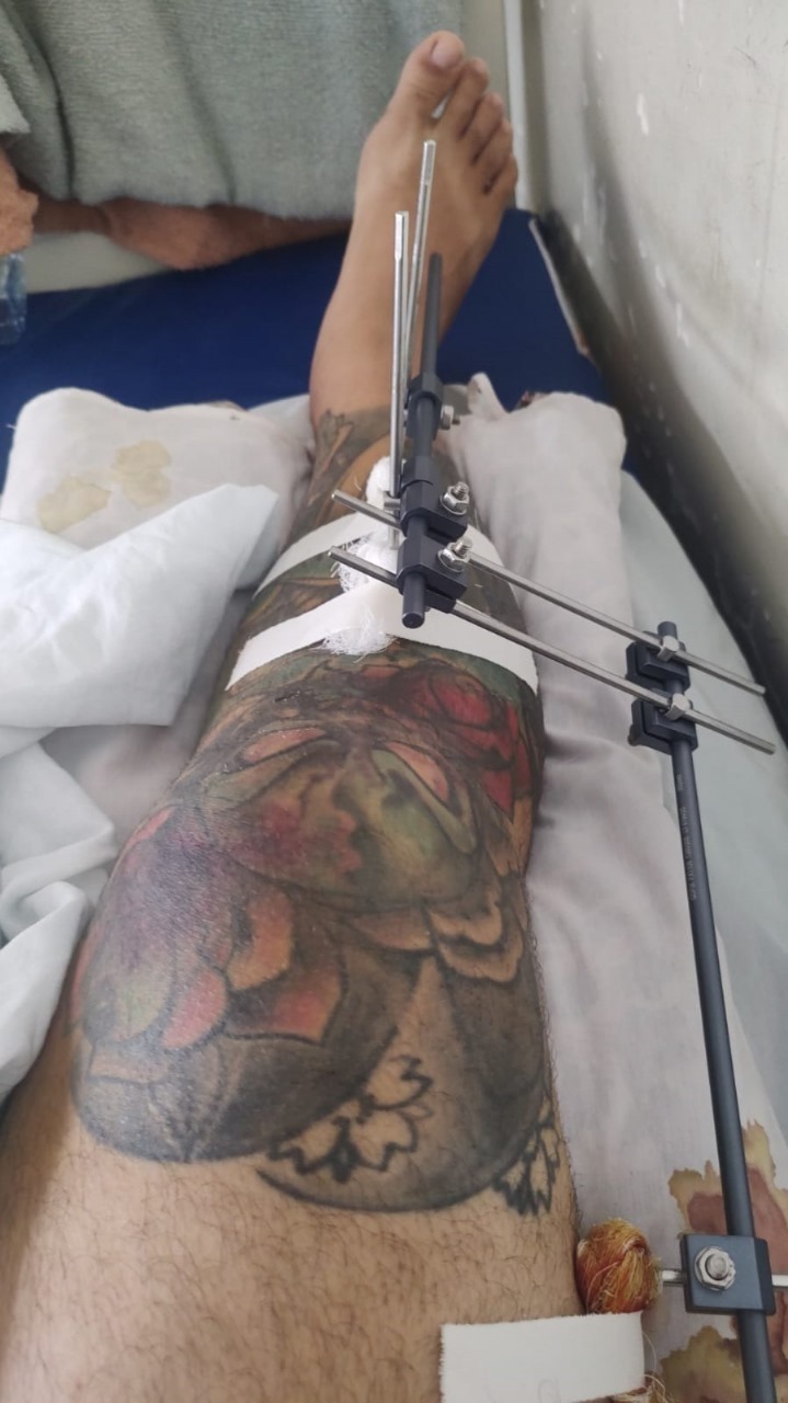Paciente aguarda cirurgia de emergência há 11 dias no Walfredo Gurgel por falta de material hospitalar