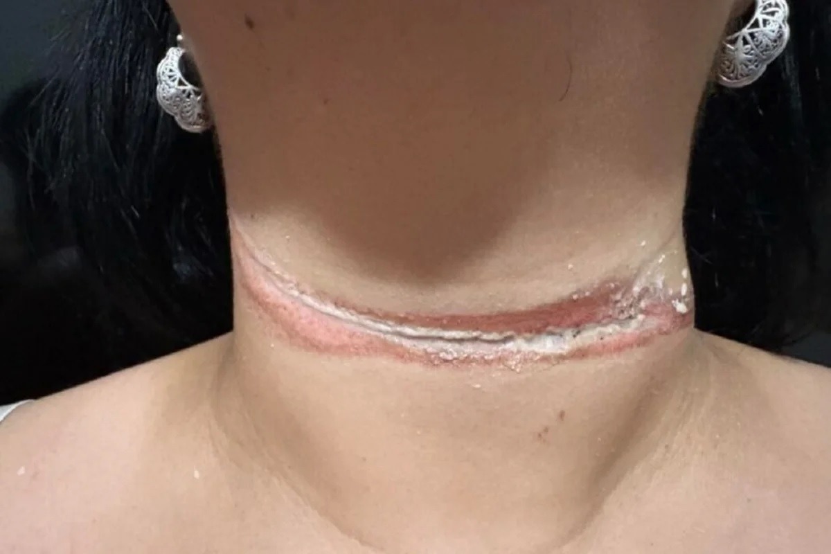 Professora quase é enforcada por fio de internet solto