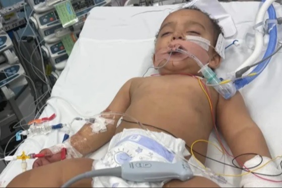 Bebê perde metade da língua após confundir soda cáustica com leite