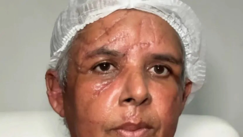 Diarista tem dedo decepado, cabelos arrancados e leva facadas do marido enquanto dormia no RN