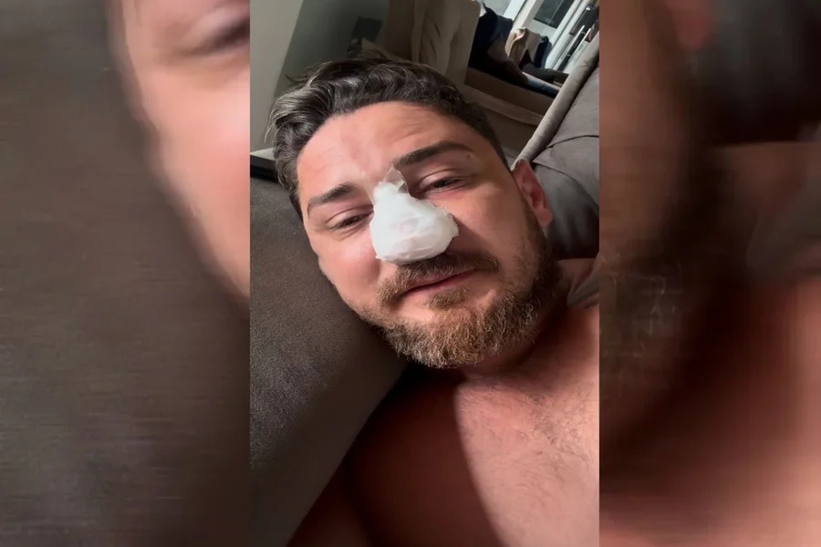 Turista agredido em Porto de Galinhas corrige 4 fraturas na face