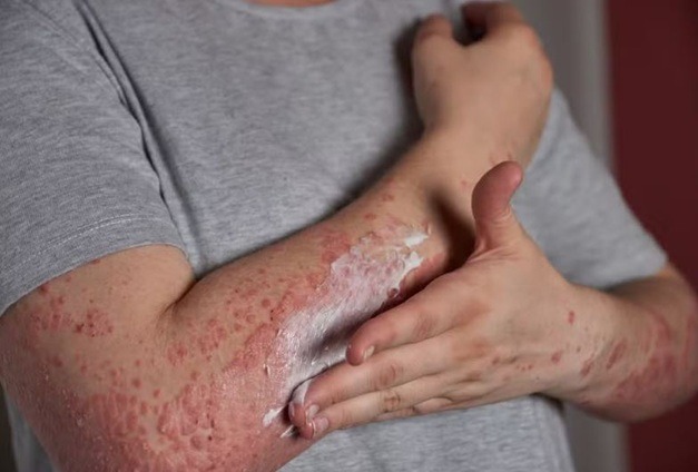 Alto custo faz Ministério da Saúde descartar vacina contra herpes-zóster no SUS