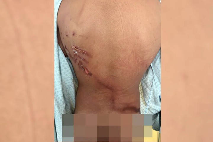 Vídeo mostra como ficou adolescente atingido por raio em ato de Nikolas Ferreira
