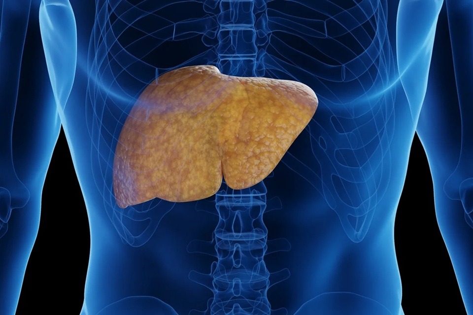 Gordura no fígado: nutricionista revela o alimento vilão do órgão