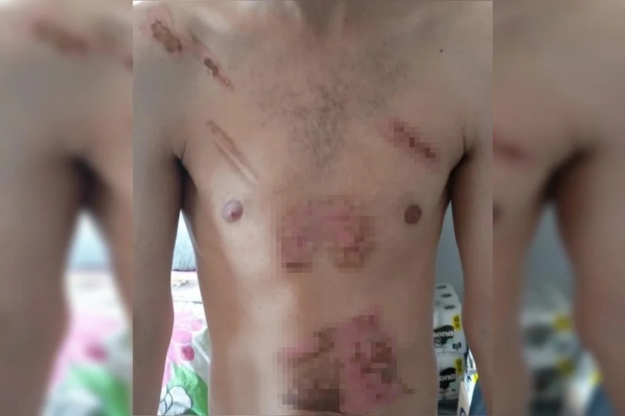 Jovem é torturado pela namorada com ferro quente e chapinha de cabelo