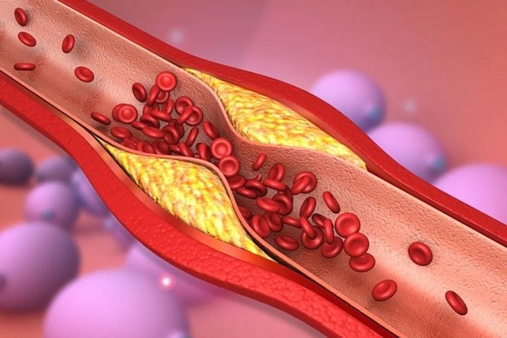 Cardiologista aponta 2 hábitos que mais deixam as artérias “entupidas”