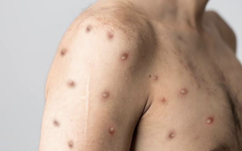 Sesap descarta caso de monkeypox em Mossoró