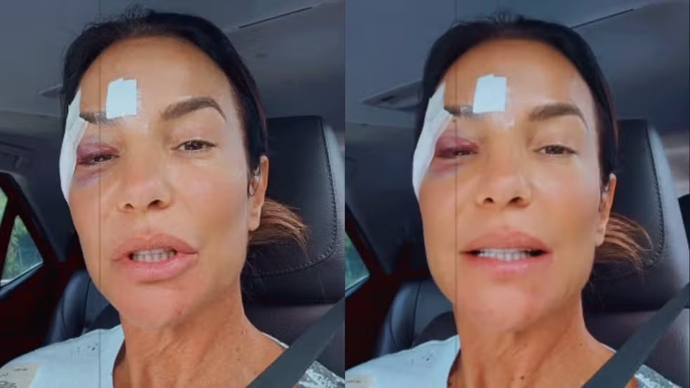 Ivete Sangalo recebe alta médica após desmaio e surge com hematoma no olho
