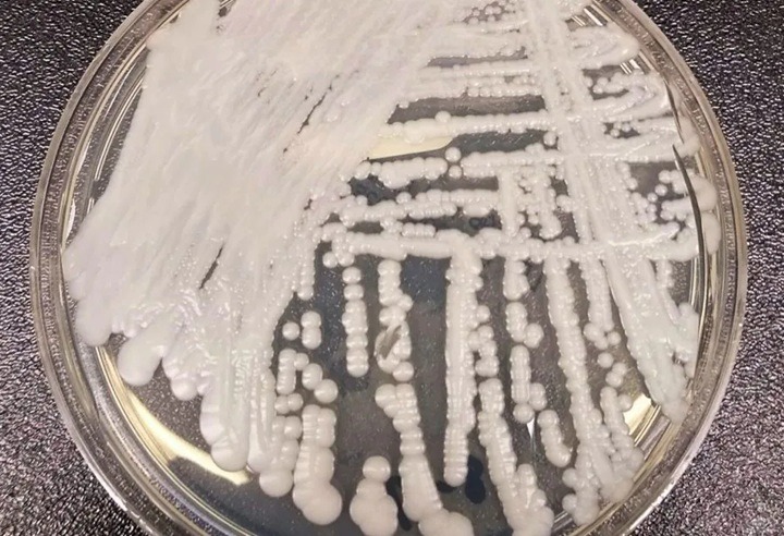 Sesap confirma nova contaminação por superfungo em hospital de Natal
