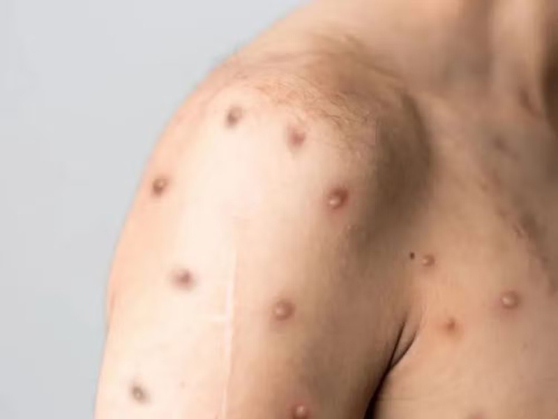 RN confirma dois primeiros casos de mpox no estado em 2026