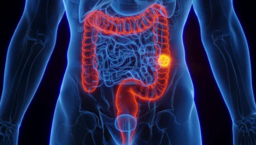 SUS adota novo exame para detectar câncer de intestino antes dos sintomas