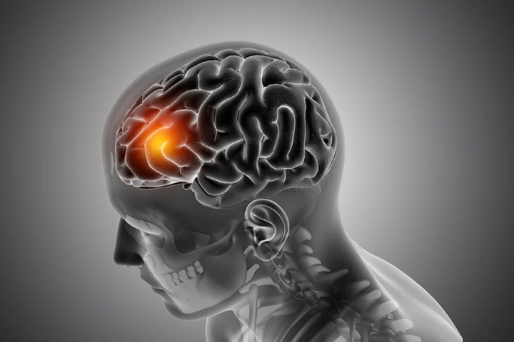 Neurologista revela sinais “silenciosos” do AVC que muita gente ignora