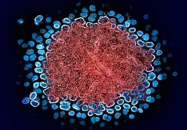 Médicos anunciam dois novos casos de cura do HIV; número de pacientes chega a 13
