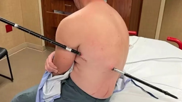 Homem caminha 16 km com bastão cravado no corpo após queda