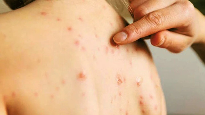Índice de vacinação contra o sarampo preocupa o RN