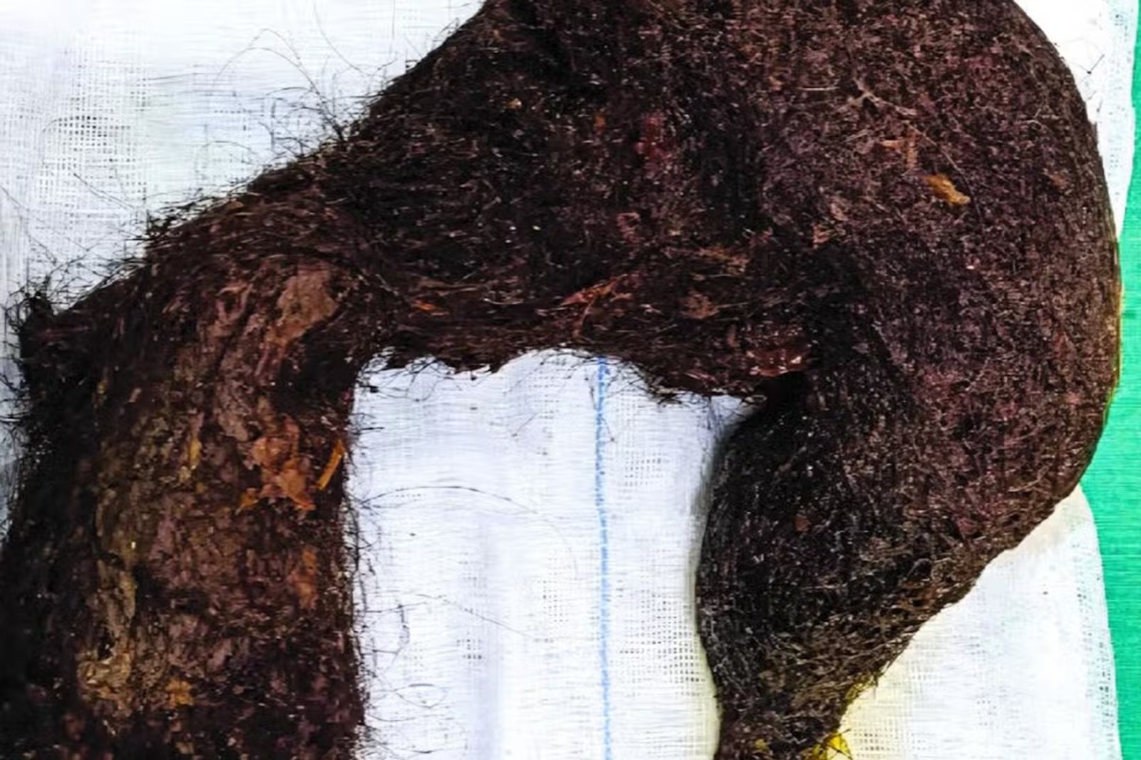 Internada com dores abdominais, mulher tinha bola de cabelo com mais de 1 kg em seu estômago