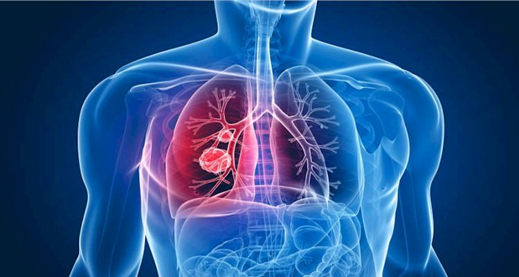 Tuberculose mata uma pessoa a cada 21 segundos no planeta