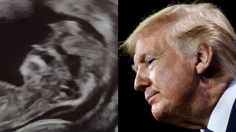 Mãe se choca ao fazer ultrassom e perceber que bebê parece com Donald Trump