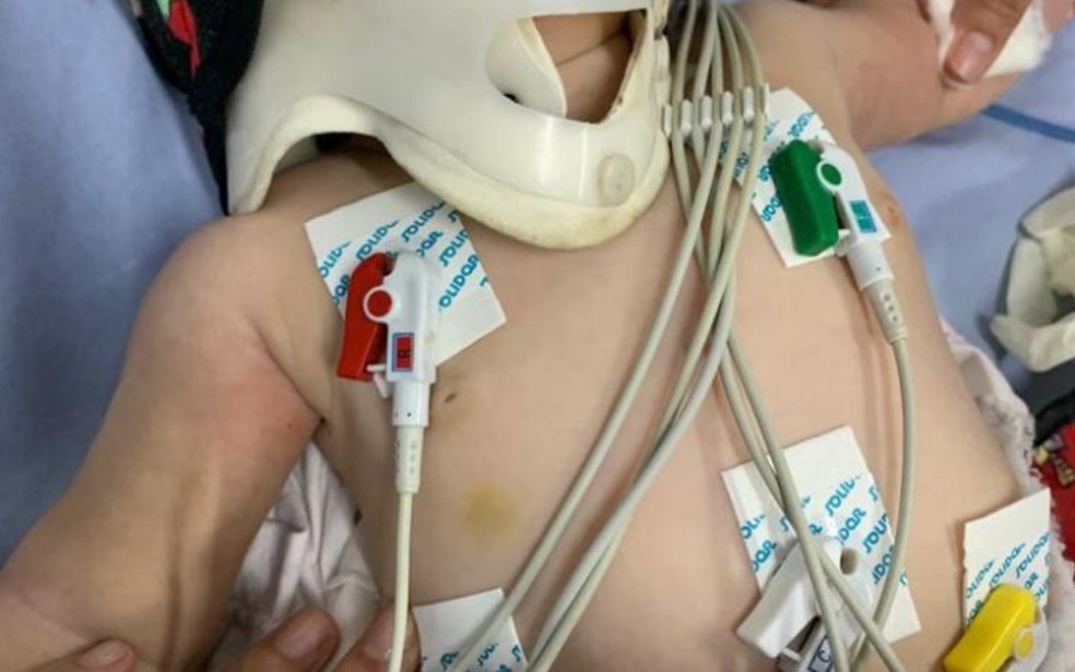 Bebê é internada em UTI com mais de 30 lesões no corpo